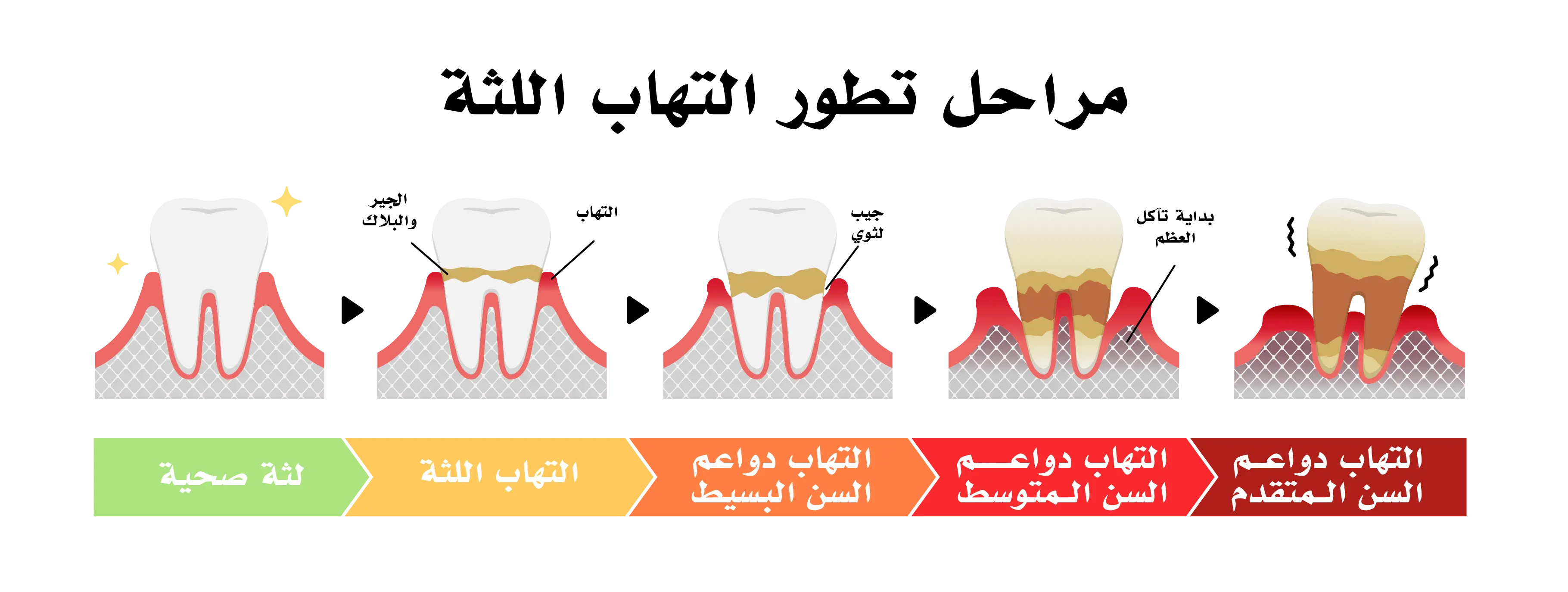 أمراض اللثة